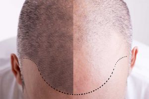 Scalp Micropigmentation, services